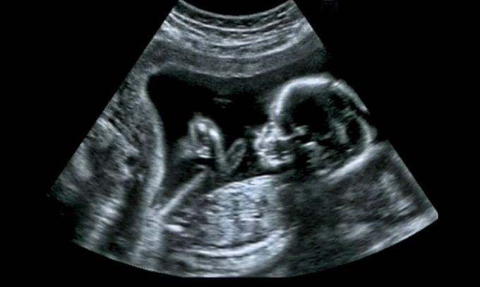 На Ямале в этом году благодаря процедуре ЭКО родилось более 80 малышей